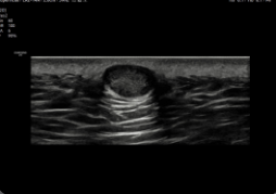 Lipoma en tejido superficial . Lipoma en tejido superficial .