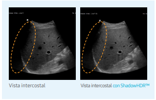 visdualIntercostal