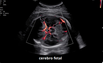 cerebro fetal