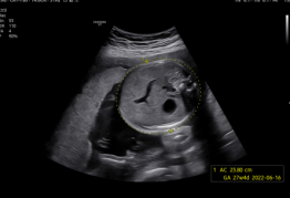 Medición de biometría fetal con BiometryAssist™ Medición de biometría fetal con BiometryAssist™