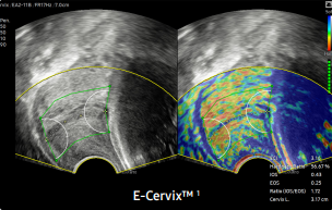 E-cervix