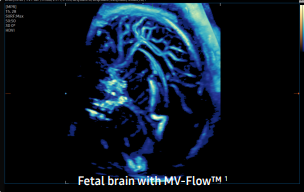 fetal brain