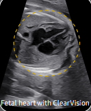 fetal heart 2.png