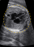 fetal heart