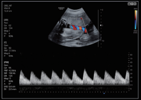 Cordón umbilical con OP