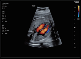 Cordón fetal con Doppler color