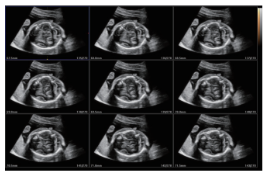 Cerebro fetal en MSV