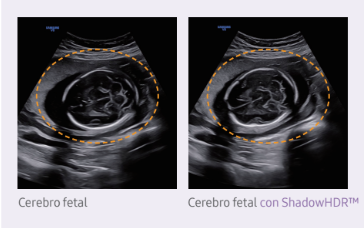 Cerebro fetal con ShadowHDRTM