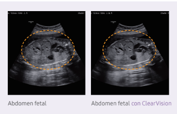 Abdomen fetal con ClearVision