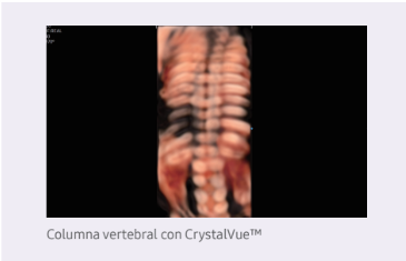 Columna vertebral con CrystalVueTM