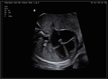 Corazón fetal con ClearVision