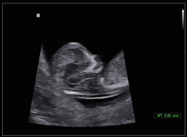 Medición NT con BiometryAssistTM