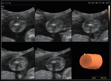 Medición del peso del feto 5D Limb Vol.TM