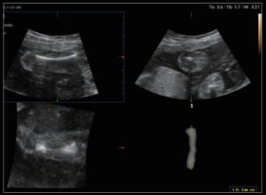 Medición del peso fetal con 5D LBTM