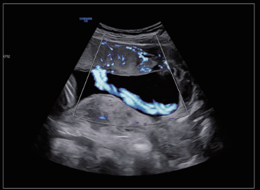 Cordon umbilical con MV-FlowTM