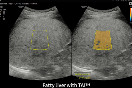 Fatty liver with TAITM
