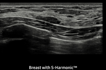 Breast with S-HarmonicTM