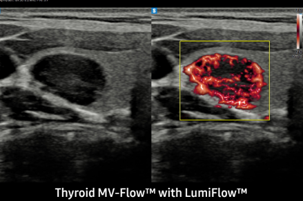 Thyroid MV-FlowTM with LumiFlowTM