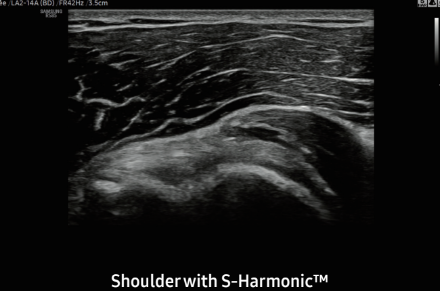 Shoulder with S-HarmonicTM