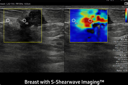 Breast with S-Shearwave ImagingTM