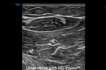 Ulnar nerve with HQ-VisionTM