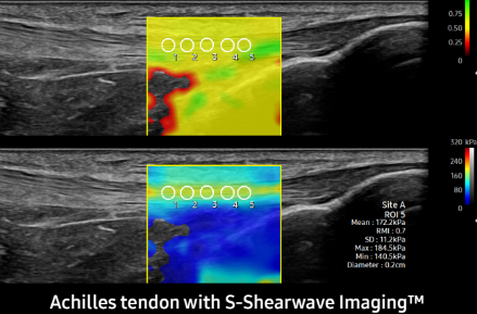 Achilles tendon with S-Shearwave ImagingTM