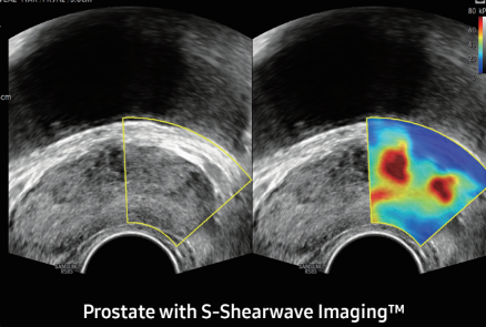 Prostate with S-Shearwave ImagingTM