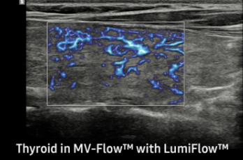 Thyroid in MV-FlowTM with LumiFlowTM