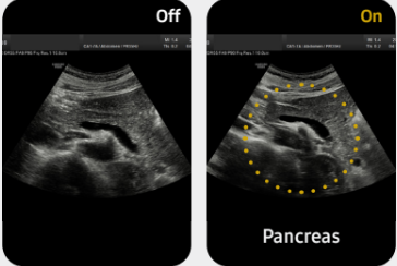 Pancreas