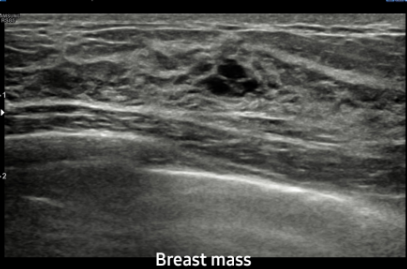 Breast mass