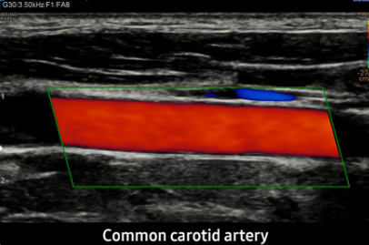 Common carotid artery