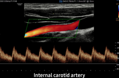 Internal carotid artery