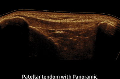 Patellar tendom with Panoramic