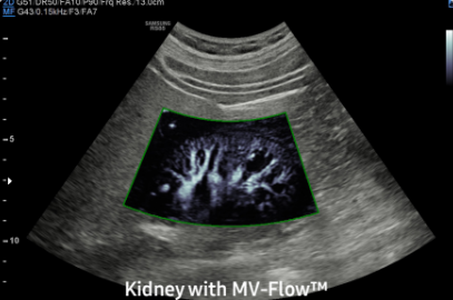 Kidney with MV-FlowTM