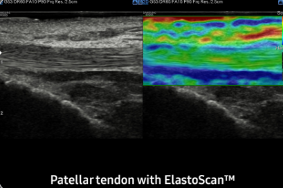 Patellar tendon with ElastoScanTM