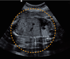 fetal-abdomen