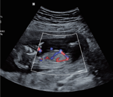 fetal-circulation