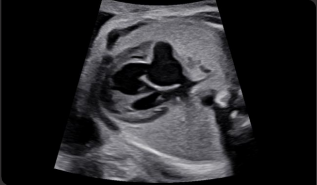 Anomalía cardíaca fetal compleja