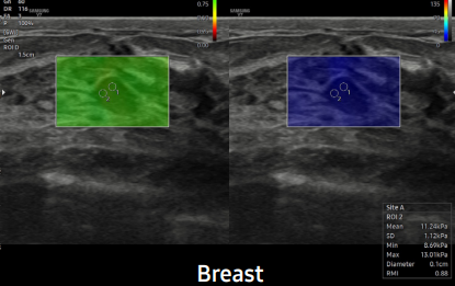 Breast