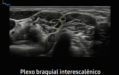 Plexo braquial interescalénico