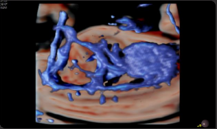 Circulación fetal con MV-Flow™¹ 3D