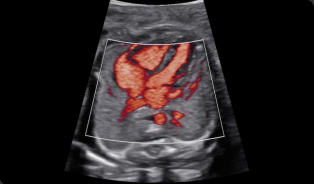 Corazón fetal con MV-Flow™¹