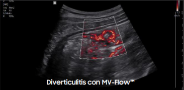 Diverticulitis con MV-Flow™