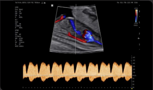 Doppler del conducto venoso