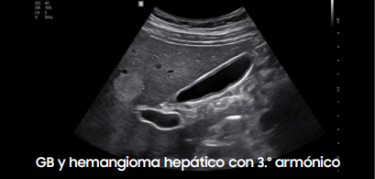 GB y hemangioma hepático con 3.º armónico