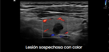 Lesión sospechosa con color