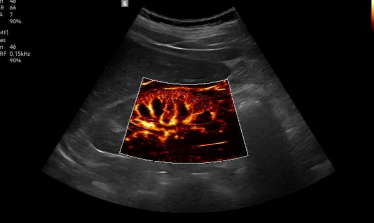 MV-Flow™ 1 renal con LumiFlow1