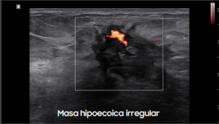 Masa hipoecoica irregular