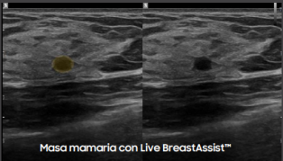 Masa mamaria con Live BreastAssist™