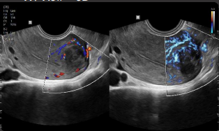 Mioma con Color y MV-Flow™¹